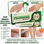 ✅ PSORIASIS™ |  Alivia la picazón y el enrojecimiento de la piel desde la primera aplicación ☀️